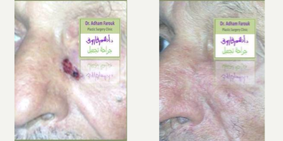 Facial Reconstructive Surgery before and after photo