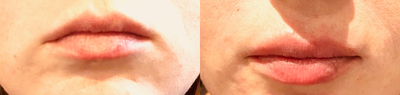 Lip Fillers before and after photo