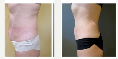 Liposuction before and after photo