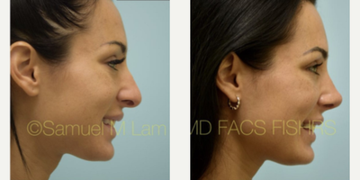 Rhinoplasty before and after photo
