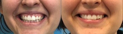 Botox before and after photo