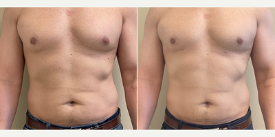 Gynecomastia Surgery before and after photo