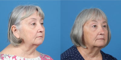 Eyelid Surgery before and after photo
