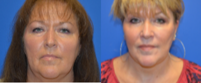 Facelift before and after photo