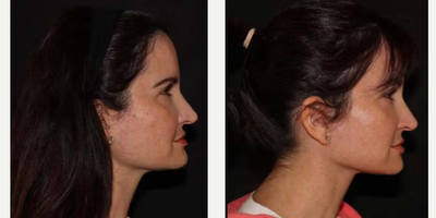 Facelift before and after photo