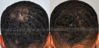 Hair Transplant before and after photo