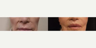 Lip Lift before and after photo