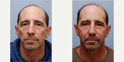 Sculptra before and after photo