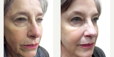 Sculptra before and after photo