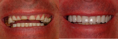 Dental Crown before and after photo