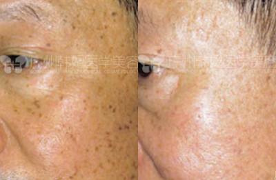 Laser Resurfacing before and after photo