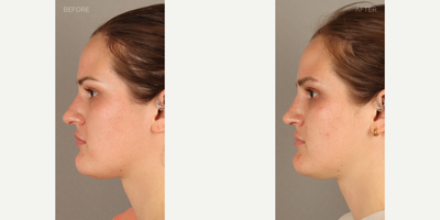 Rhinoplasty before and after photo