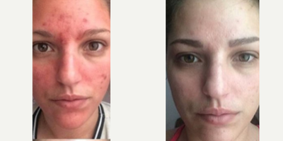 Skin Rejuvenation before and after photo