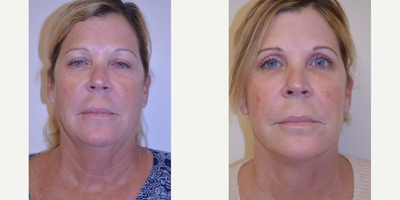 Facelift before and after photo