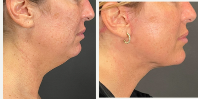 Facelift before and after photo
