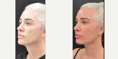 Facial Fat Transfer before and after photo