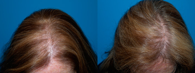 Hair Transplant before and after photo