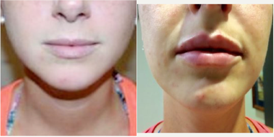 Restylane Silk before and after photo