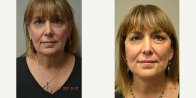 Facelift before and after photo
