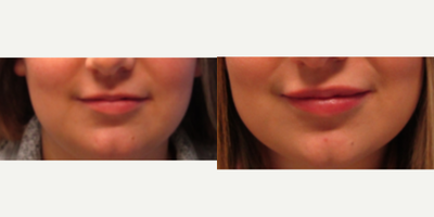 Juvederm before and after photo