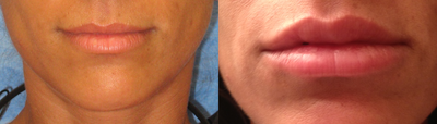 Juvederm before and after photo