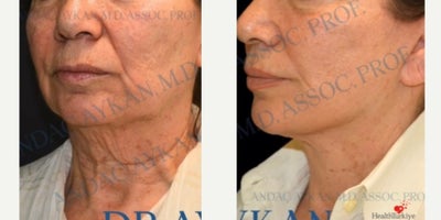 Neck Lift before and after photo