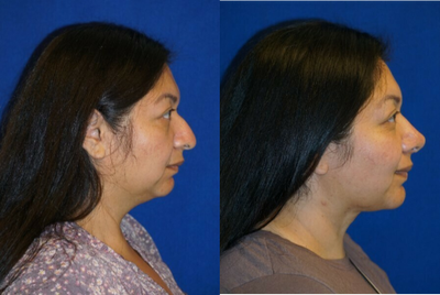 Rhinoplasty before and after photo