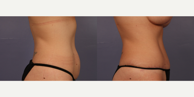 Tummy Tuck before and after photo