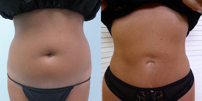 CoolSculpting before and after photo