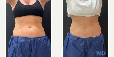 Emsculpt before and after photo