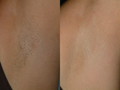 Laser Hair Removal before and after photo