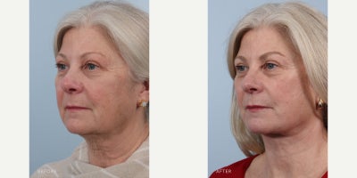 Rhinoplasty before and after photo