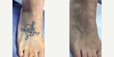 Tattoo Removal before and after photo
