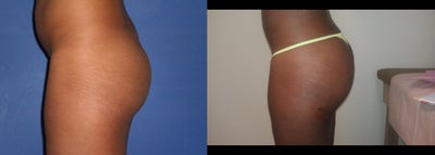 Butt Augmentation before and after photo