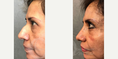 Eyelid Surgery before and after photo