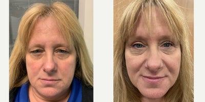 Eyelid Surgery before and after photo