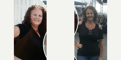 Gastric Sleeve Surgery before and after photo