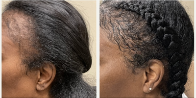Hair Transplant before and after photo