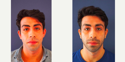 Ear Surgery before and after photo