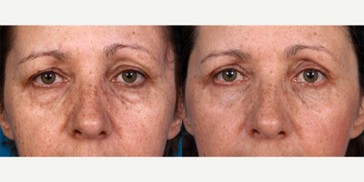Eyelid Surgery before and after photo
