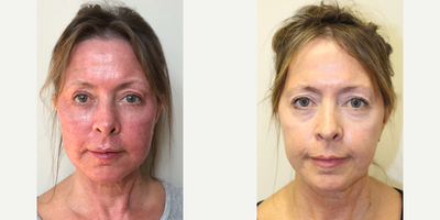 Laser Resurfacing before and after photo