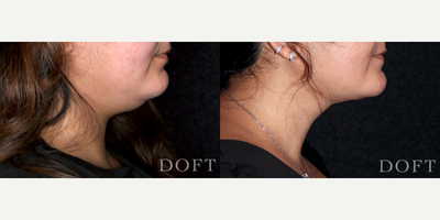Liposuction before and after photo