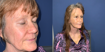 Revision Rhinoplasty before and after photo