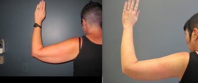 Arm Lift before and after photo
