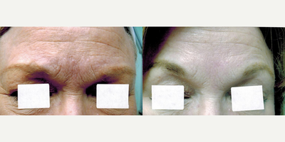 Botox before and after photo