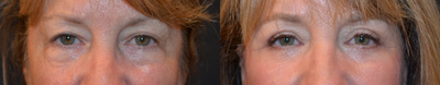 Eyelid Surgery before and after photo