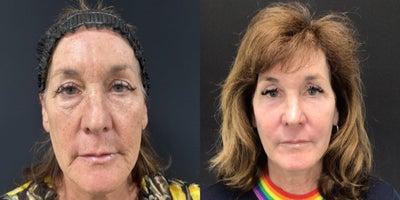 Facial Fat Transfer before and after photo