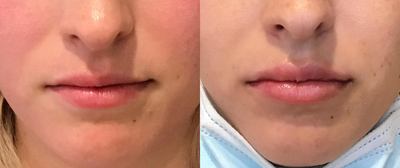 Juvederm before and after photo