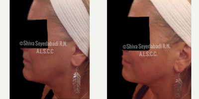 Liquid Facelift before and after photo