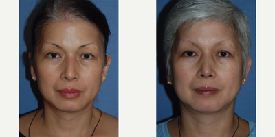 Rhinoplasty before and after photo